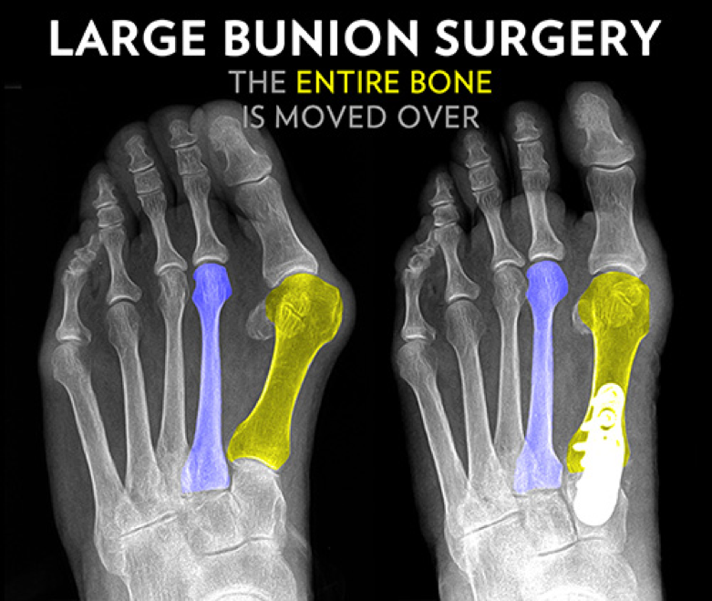 Seaview Orthopaedic Bunion Surgery