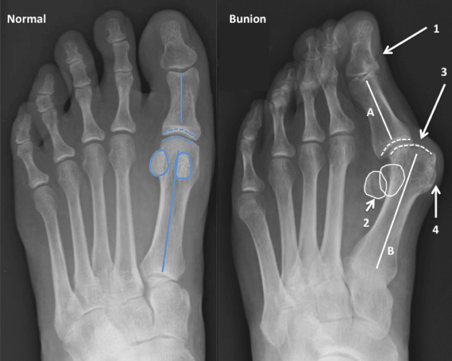 bunionectomy x ray