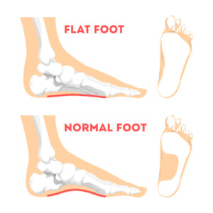 Flat Feet | Seaview Orthopaedic 