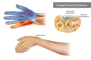 Carpal tunnel syndrome CTS. Compressed median nerve. Anatomy of the carpal tunnel, showing the median nerve.