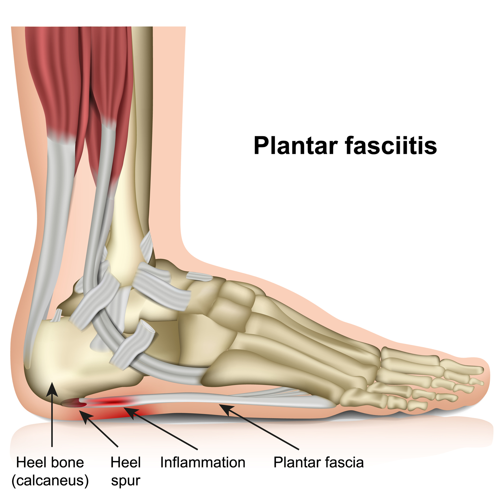 A diagram highlighting plantar fasciitis and the areas it affects.