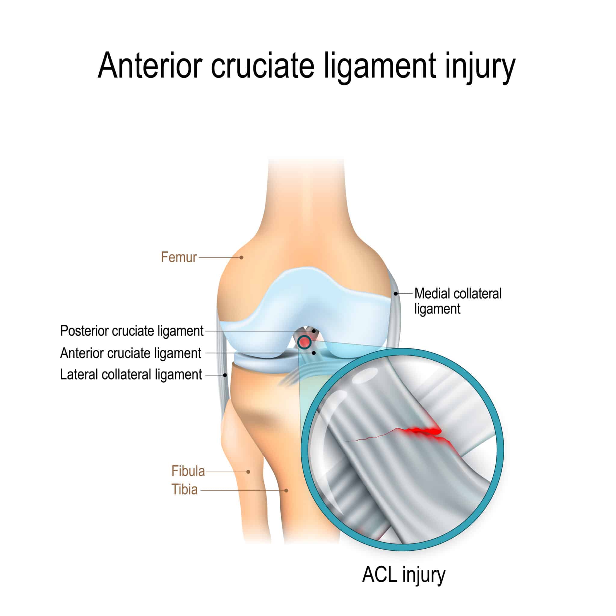 BEAR ACL The Innovative New Implant for Torn ACL Seaview Orthopaedics