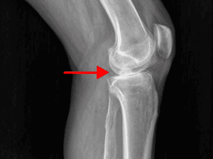 xray of osteoarthritis in the knee, knee arthritis, 