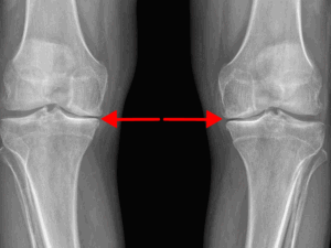 xray of knee arthritis, xray of osteoarthritis in the knee, knee x ray