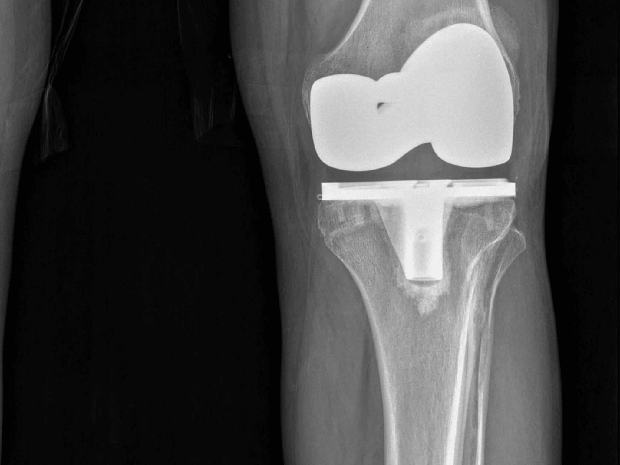 When Is It Time For A Knee Replacement