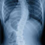 scoliosis x ray, xray of child with scoliosis